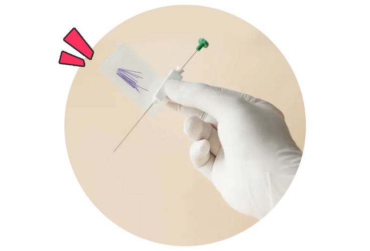 埋线减肥用的是什么线