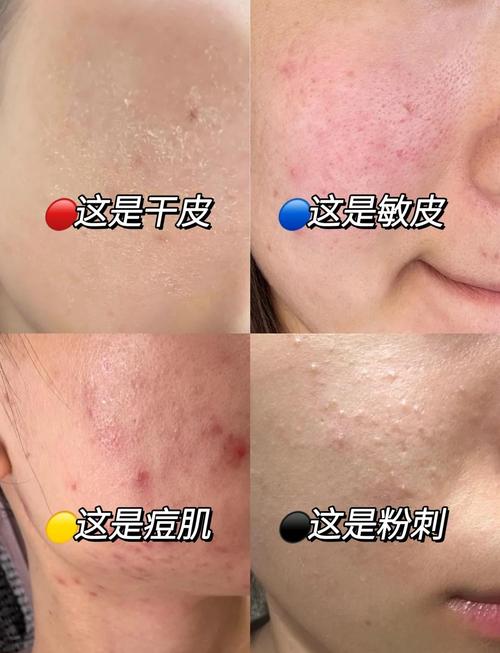 洗面奶过敏有什么办法