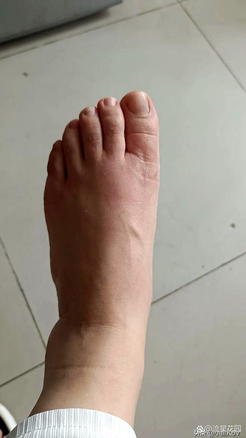 脸肿脚肿是什么病