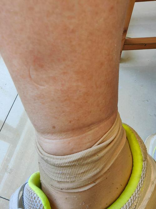 脸肿脚肿是什么病