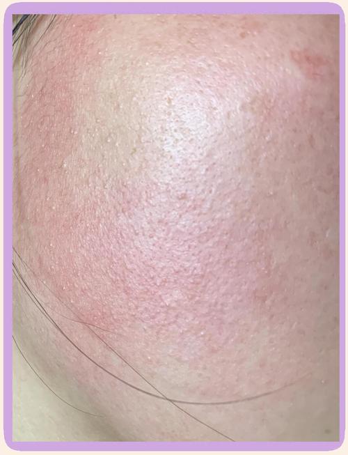 呼吸37度洗面奶过敏