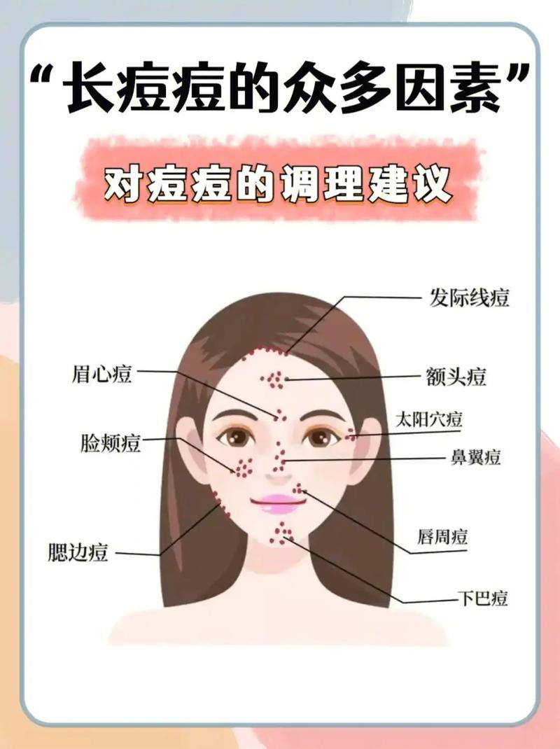 为什么会起痤疮