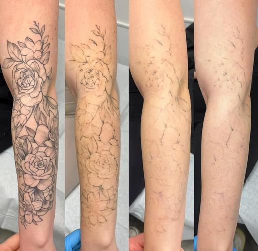 纹身用什么可以洗掉