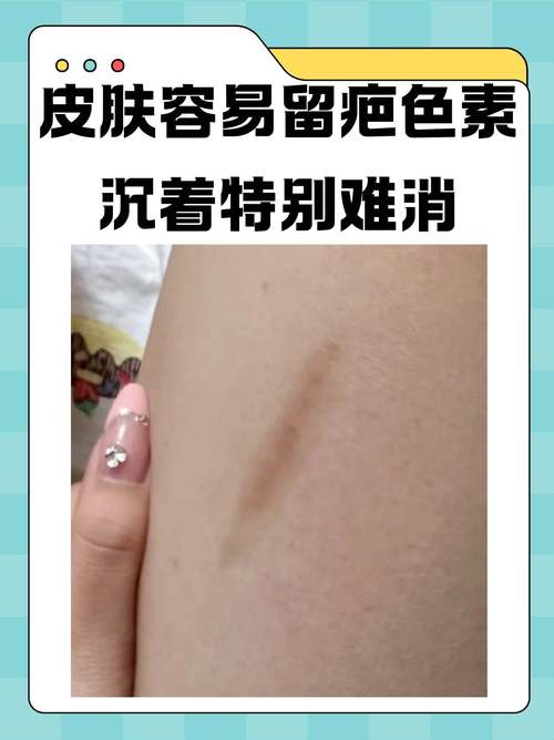 什么情况下会留疤