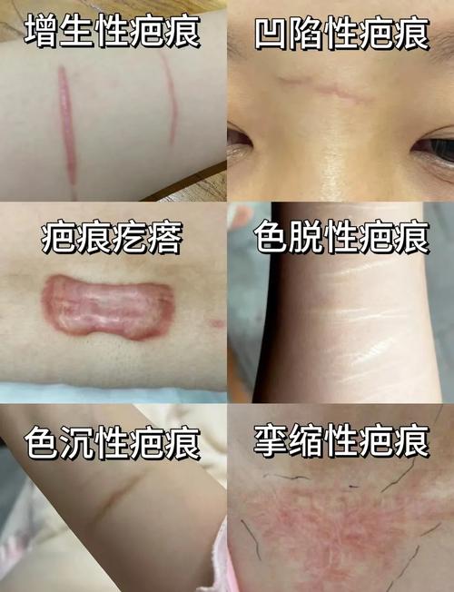 什么情况下会留疤