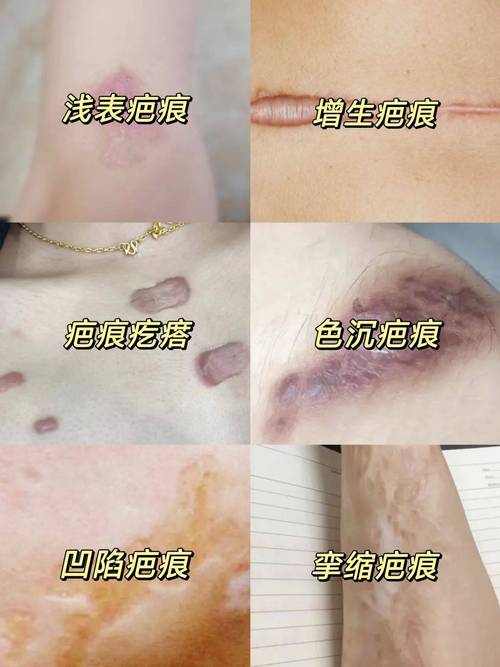 什么情况下会留疤