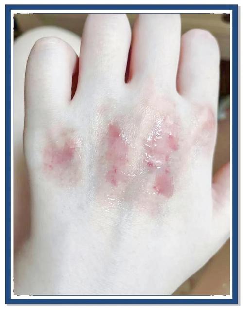 烫伤抹什么不留疤