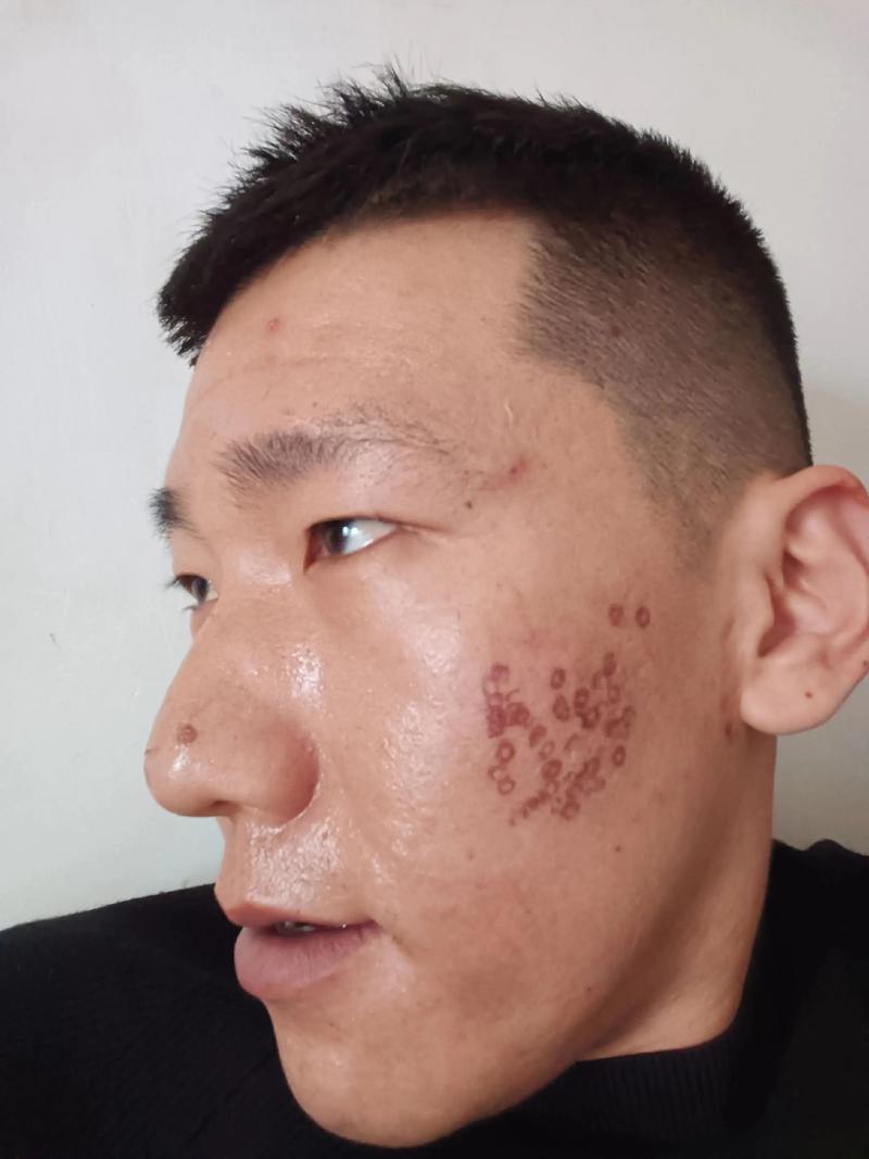 什么是点阵激光