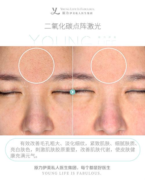 什么是点阵激光