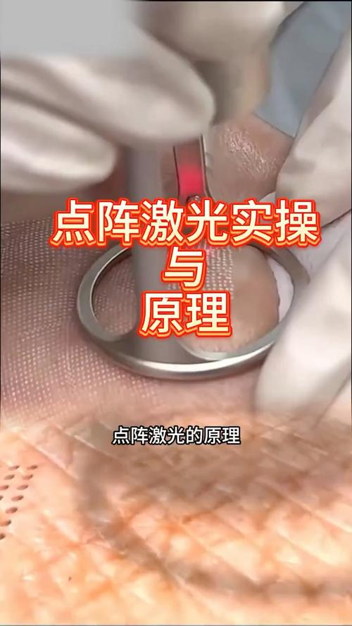 什么是点阵激光