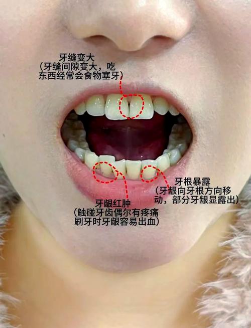 牙龈萎缩什么症状