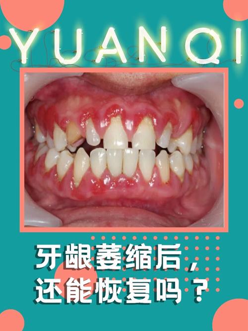 牙龈萎缩什么症状