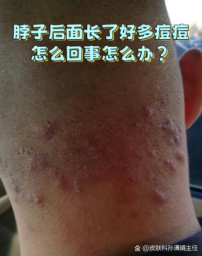 脖子为什么会长痘痘