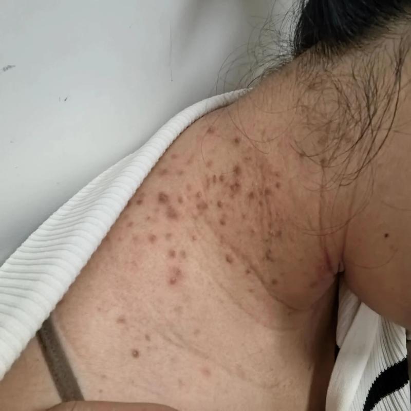 脖子为什么会长痘痘