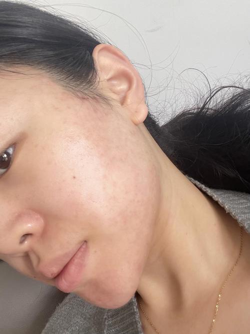 有痘痘能用磨砂洗面奶