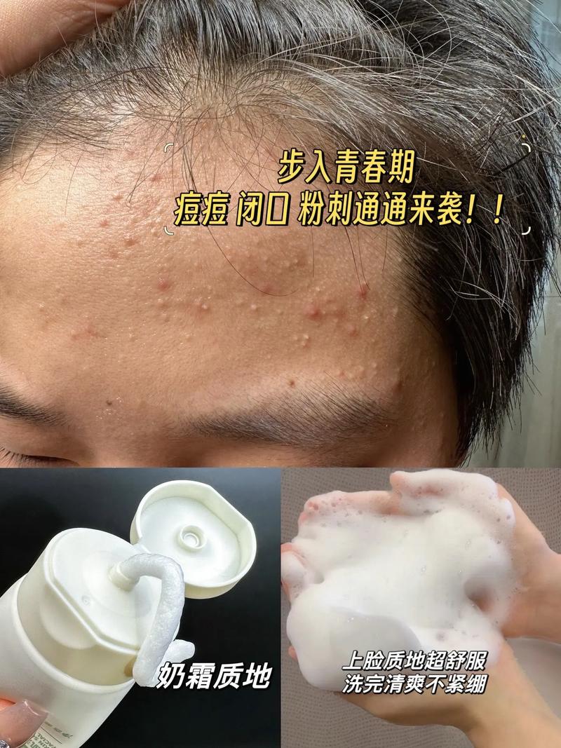 闭合性粉刺可以洗面奶