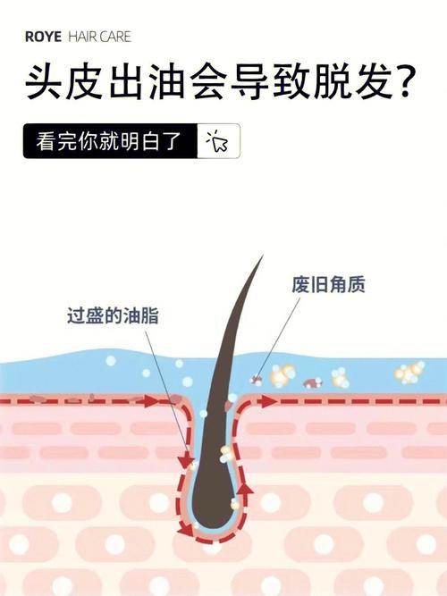 头皮出油是什么原因