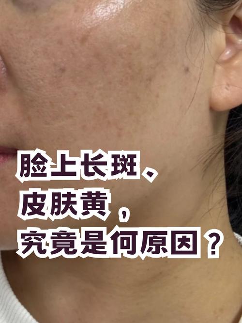 脸蜡黄是什么原因