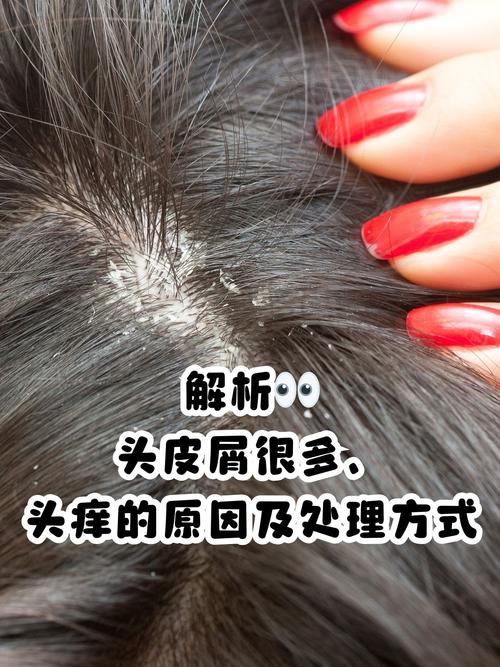为什么那么多头皮屑