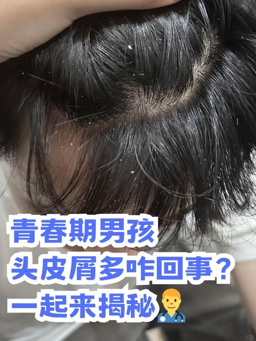 为什么那么多头皮屑
