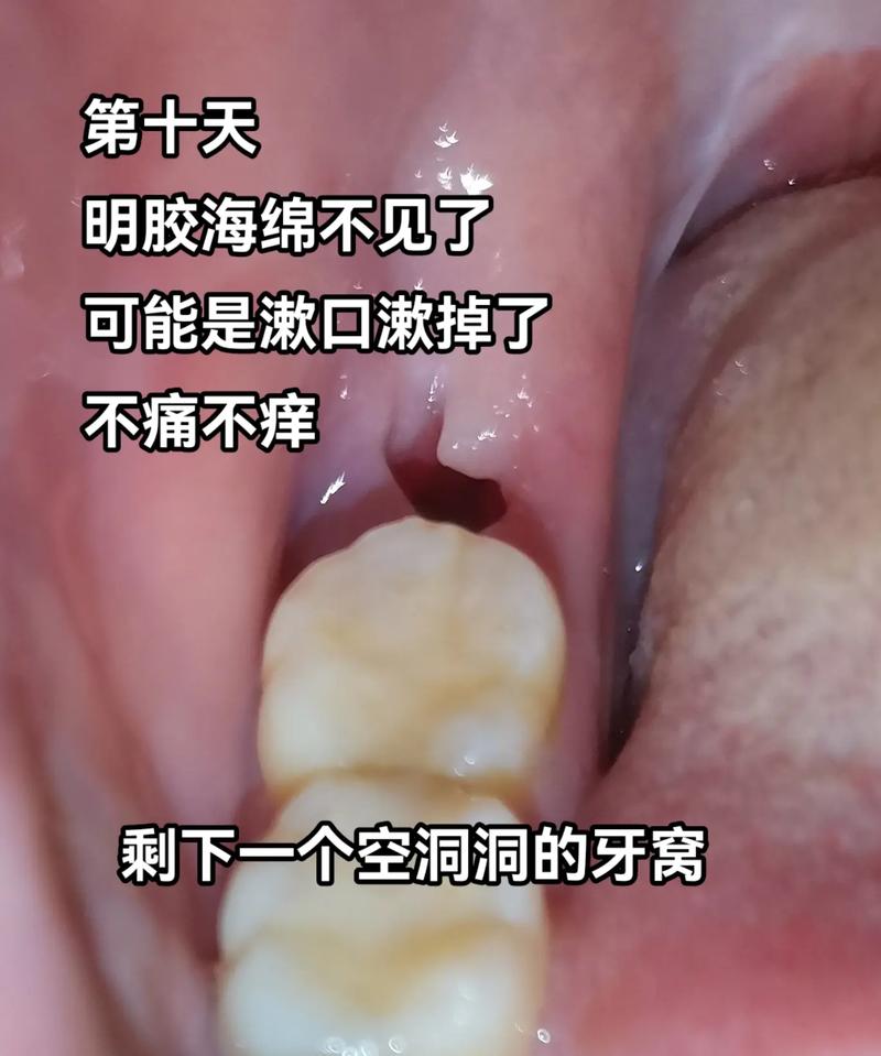 拔牙有什么后遗症