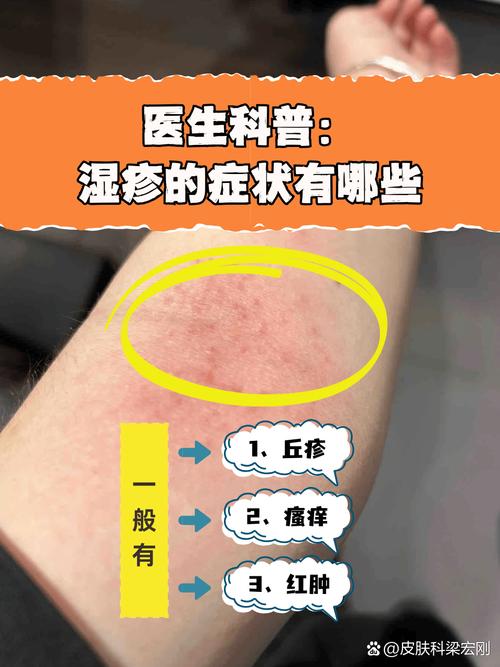 为什么要长湿疹