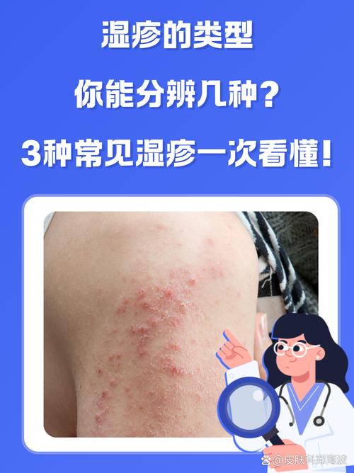 为什么要长湿疹