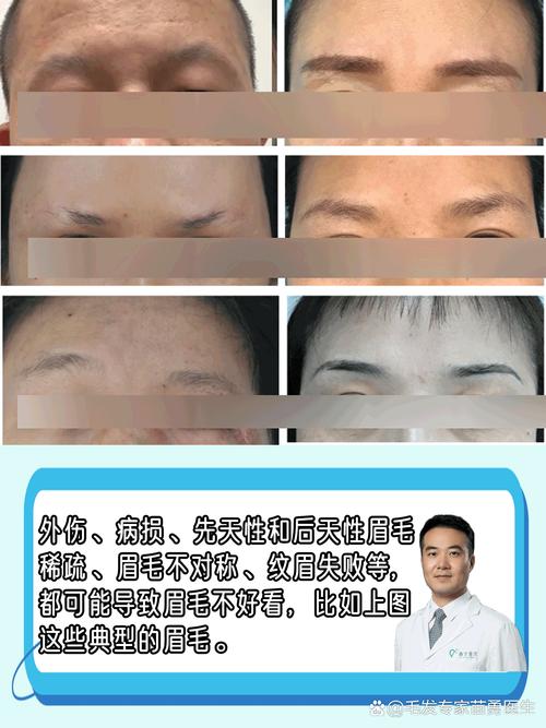 为什么眉毛不对称