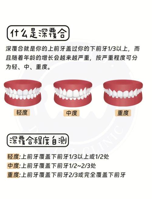 深覆合什么意思