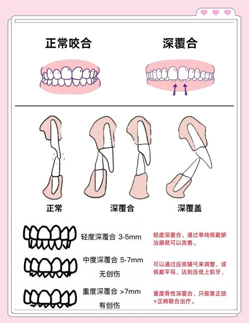 深覆合什么意思