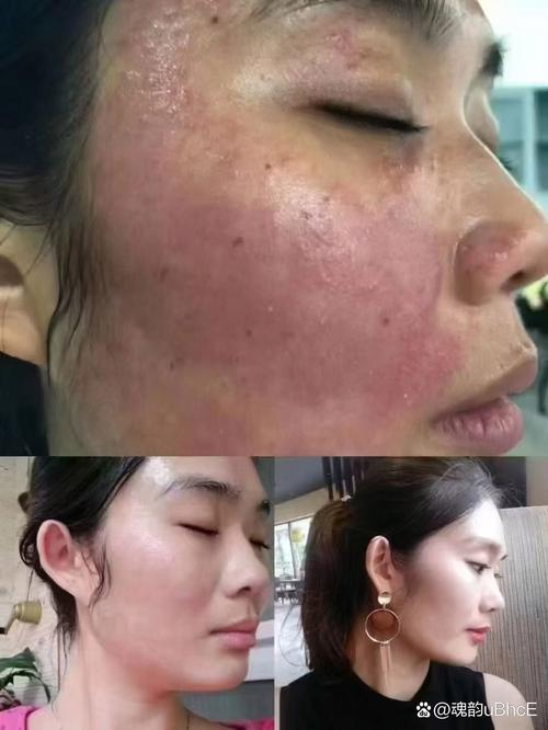 激素皮炎能用洗面奶吗