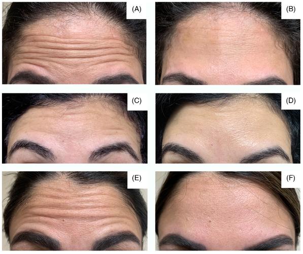 额头皱纹叫什么