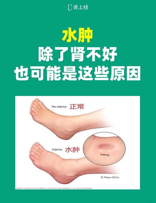 减肥时为什么人水肿
