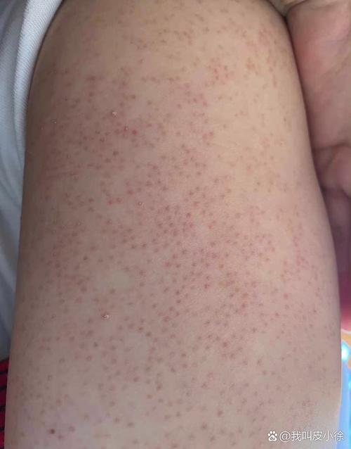 为什么会长鸡皮肤