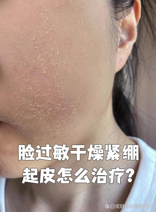 脸过敏了还能擦护肤品吗