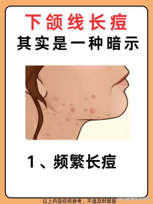 下巴起痘是什么原因