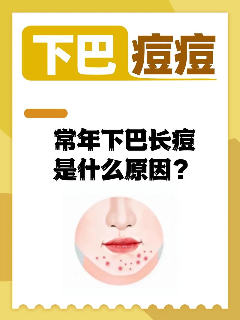 下巴起痘是什么原因