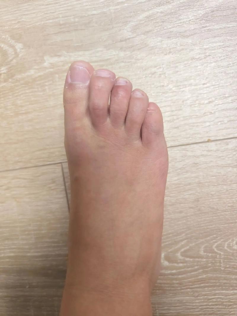 脚为什么会冻疮