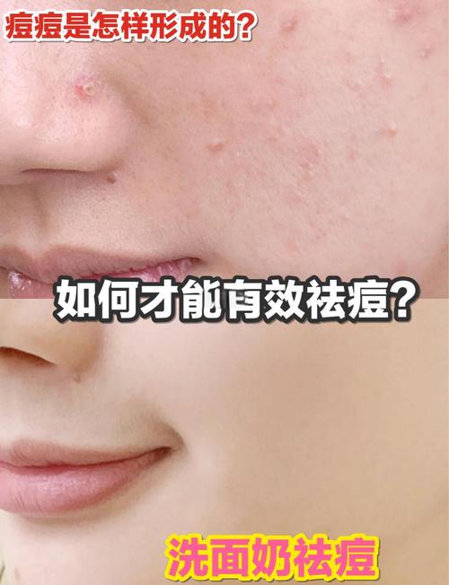 脸上有豆豆能用洗面奶