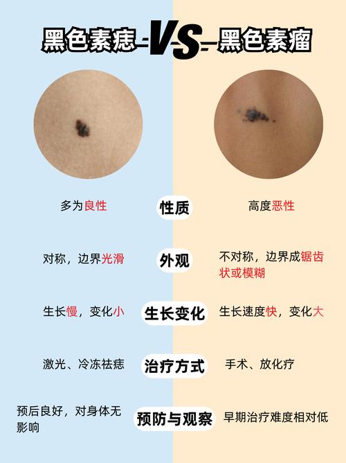 为什么突然会长痣