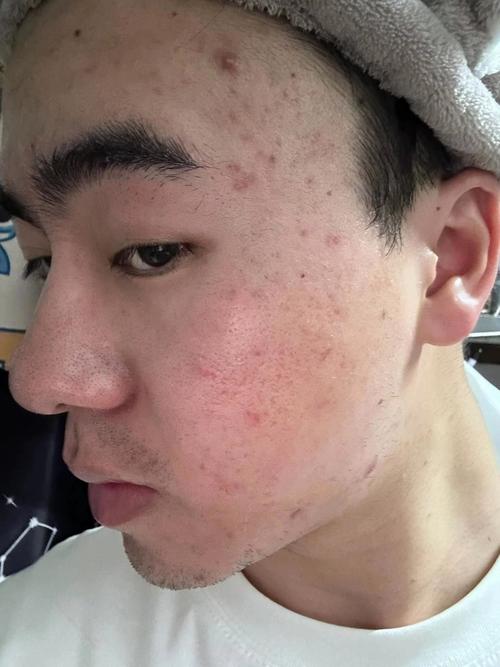 男士洗面奶洗完长痘痘