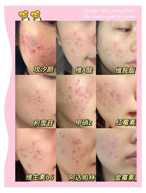 脸上有痘印用什么护肤品