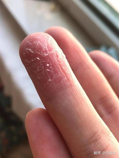 手指蜕皮缺什么