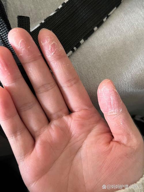 手指蜕皮缺什么