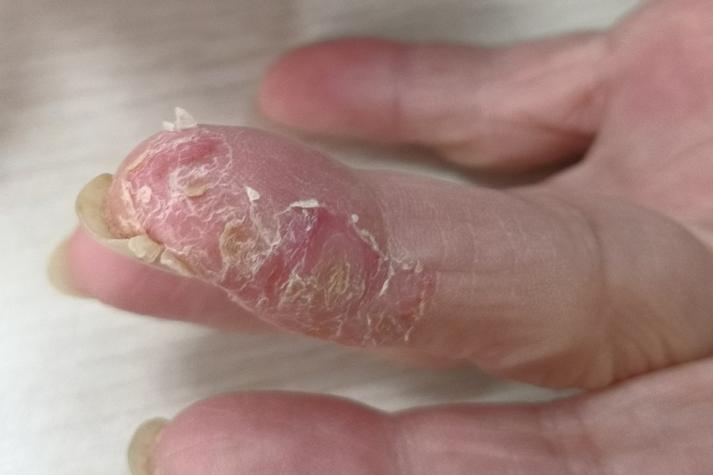 手指蜕皮缺什么