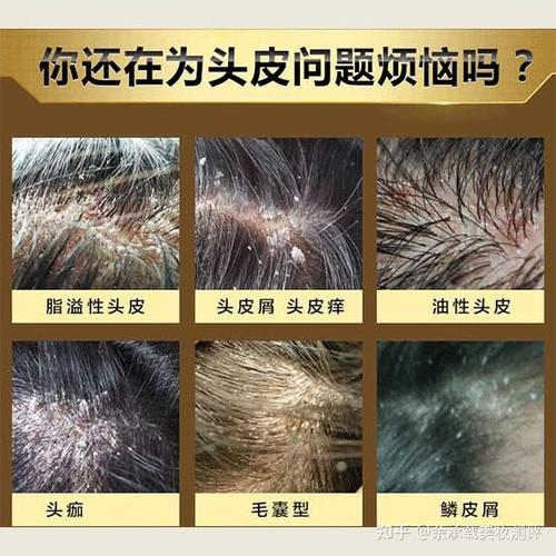 头皮屑为什么会痒