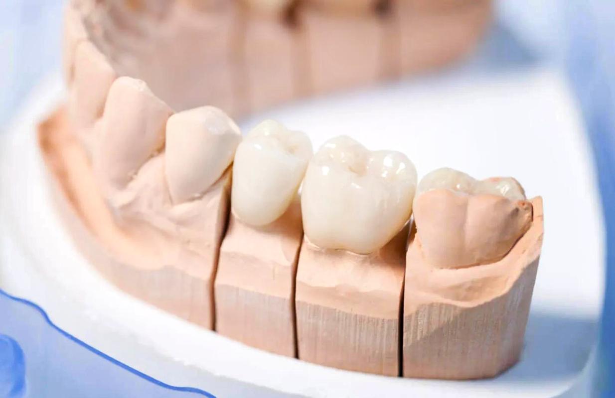 烤瓷牙什么材料好