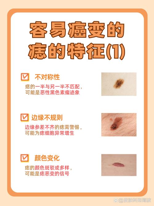 什么是痣什么是斑