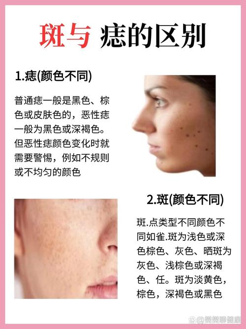 什么是痣什么是斑