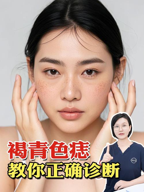 什么是痣什么是斑